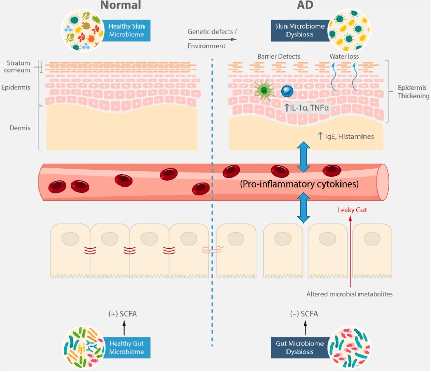 Contribution Of Gut And Skin Microbiome To The Pathogenesis Of Ad Under Normal